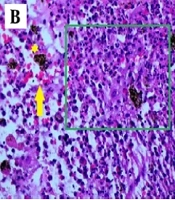 Birefringent Trails: A Case Report Unveiling Heroin-Adulterant Granulomas Masquerading Sporotrichoid Nodular Lymphangitis