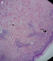 A Case Report of Localized Bullous Sweet’s Syndrome Associated with Metabolic Syndrome