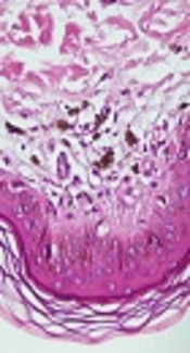 Lichen Planus Distributed Along the Lines of Blaschko: A Case Report