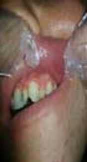 Comparing the Effect of Injectable Vitamin B With Conventional Oral Treatment on Aphthous Stomatitis