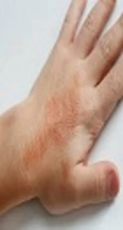 Psoralen and UltraViolet A in Atopic Dermatitis