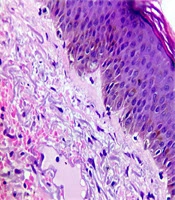 Solar Elastotic Bands of the Forearm: An Extremely Rare Presentation