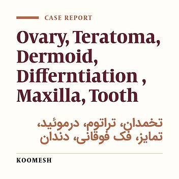 Maxillary bone containing five well developed teeth in ovarian dermoid cyst