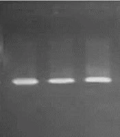 Investigation of the Biochemical Changes of Sialidosis Disease and Its Relationship with NEU1 Gene in Two Khuzestanian Families by WES Method
