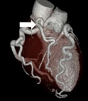 A Young Woman with Atypical Chest Pain: Introducing a Rare Case of ARCAPA