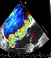 Complicated AMI in a COVID-19 Patient; Chordal Rupture and Flail of Mitral Valve
