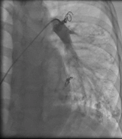 Unusual Course of Pulmonary and Brain Arteriovenous Malformation: A Case Report