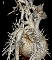 Report of the Second Bi-monthly Virtual Meeting of the Iranian Society of Cardiac Surgeons: Investigation of Three Interesting Cases