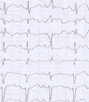 Cover image of the article: Right Coronary Artery Origin from Left Sinus of Valsalva with an Inter-arterial Course: Case Report and Review of Literature