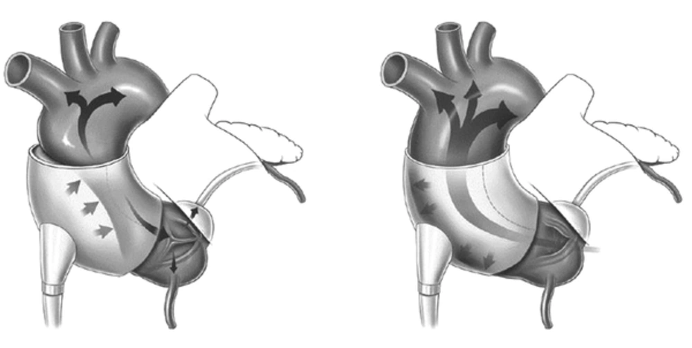 The C-Pulse Cuff Inflates to Allow the Heart to Fill with Blood (Left) and the Heart Pumps as the Cuff Deflated (Right) (Cite: www.sunshineheart.com).