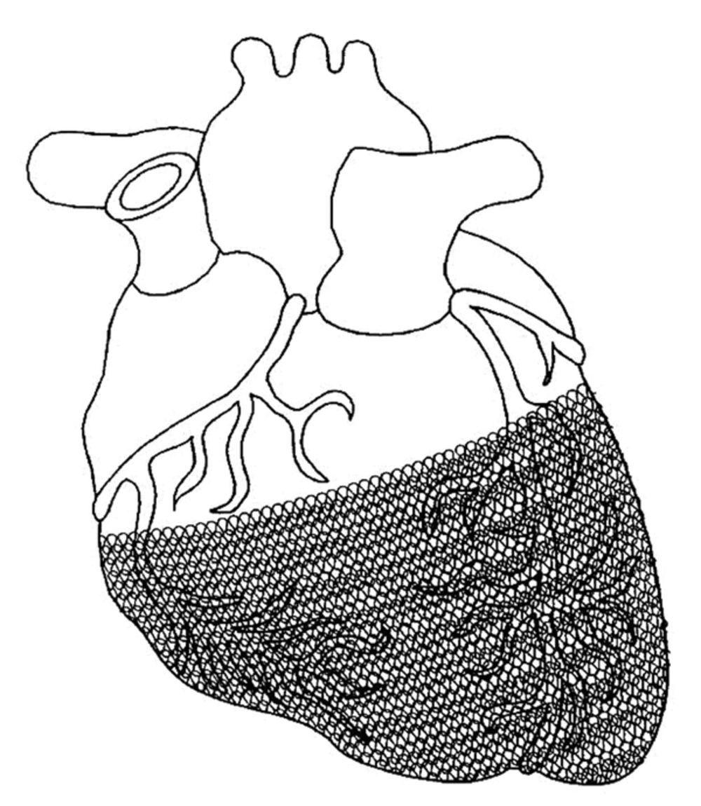 CorCap Cardiac Support Device for Reducing Deleterious Wall Tension and Resisting Ventricular Shape Changes (Cite: Lilip L, et al. US patent 6682474 B2, Jan.27, 2004).