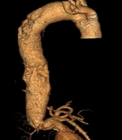 Cover image of the article: Gallbladder Necrosis Following Fenestrated Endovascular Aneurysm Repair