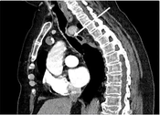 Endovascular Management for an Aberrant Right Subclavian Aneurysm