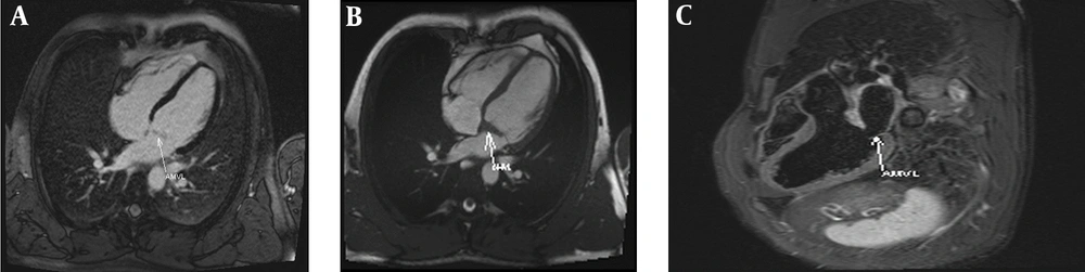 A, Orthogonal trans thoracic echocardiography (TTE) view; B, apical 4 chamber TTE view; C, para sternal long axis TTE view ;and D, parasternal trans esophageal echocardiography view which demonstrates lipomatous change of mitral valve annulus and hypoplastic anterior mitral valve leaflet without significant stenosis. The arrow points to hypoplastic anterior mitral valve leaflet. A, Orthogonal trans thoracic echocardiography (TTE) view; B, apical 4 chamber TTE view; C, para sternal long axis TTE view ;and D, parasternal trans esophageal echocardiography view which demonstrates lipomatous change of mitral valve annulus and hypoplastic anterior mitral valve leaflet without significant stenosis. The arrow points to hypoplastic anterior mitral valve leaflet.