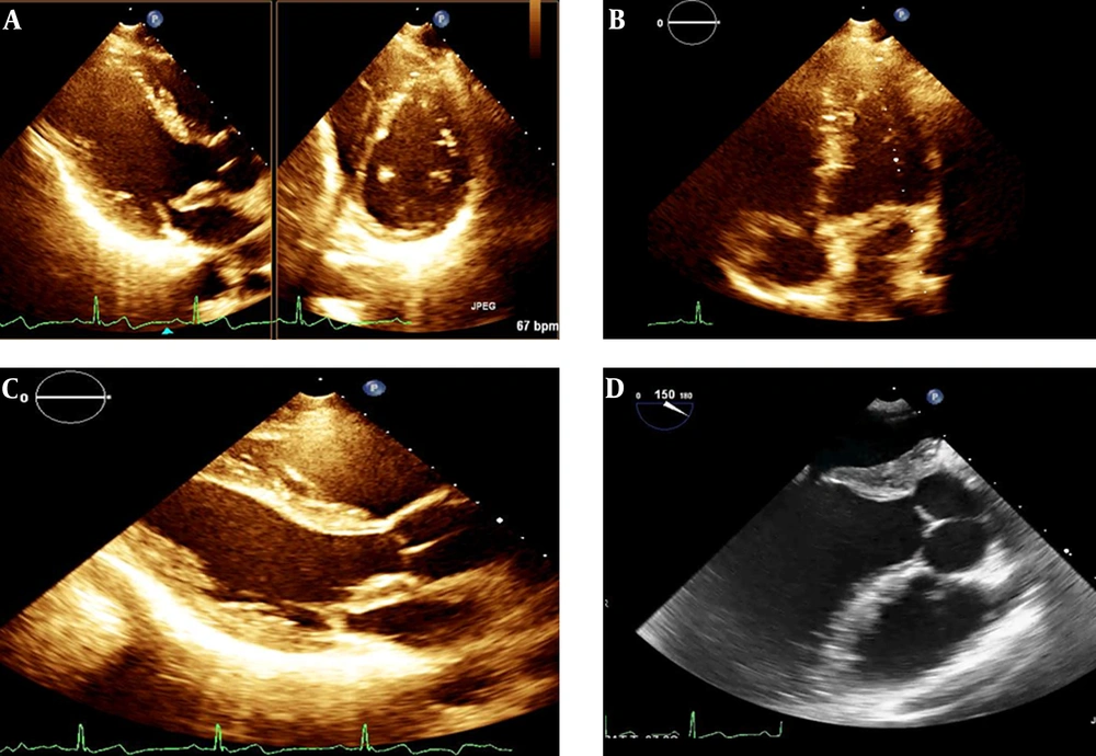 A, Late gadolinium enhancement cardiac magnetic resonance (CMR) imaging showed thickening and fibrosis replacement of intervalvular fibrosa which extended to anterior mitral valve leaflet; B, 4 chamber CMR image demonstrated restricted mitral valve annulus with subsequent restricted MV opening without significant mitral stenosis or regurgitation; C, 3 chamber STIR CMR image confirms these findings. A, Late gadolinium enhancement cardiac magnetic resonance (CMR) imaging showed thickening and fibrosis replacement of intervalvular fibrosa which extended to anterior mitral valve leaflet; B, 4 chamber CMR image demonstrated restricted mitral valve annulus with subsequent restricted MV opening without significant mitral stenosis or regurgitation; C, 3 chamber STIR CMR image confirms these findings.