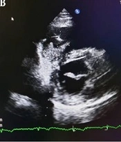 Fever of Unknown Origin with Cardiac Mass: Challenging and Interesting Case