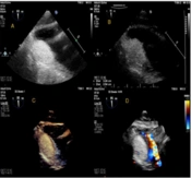 Cover image of the article: ECG Changes in a Young Lady Candidate for In Vitro Fertilization Due to Left Ventricular Hemangioma