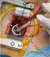 First Successful HAART Ring-Assisted Aortic Valve Repair via Right Anterior Thoracotomy Approach