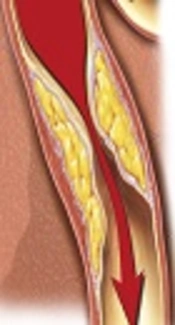 Impact of Procaine Hydrochloride Versus Lidocaine in Cardioplegic Solution, on Reperfusion Arrhythmia During Coronary Artery Bypass Graft Surgery