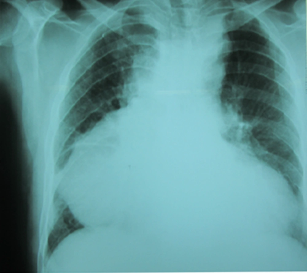 Shows Global Cardiac Enlargement with Dumping of Right Cardio-Phernic Angle Shows Global Cardiac Enlargement with Dumping of Right Cardio-Phernic Angle