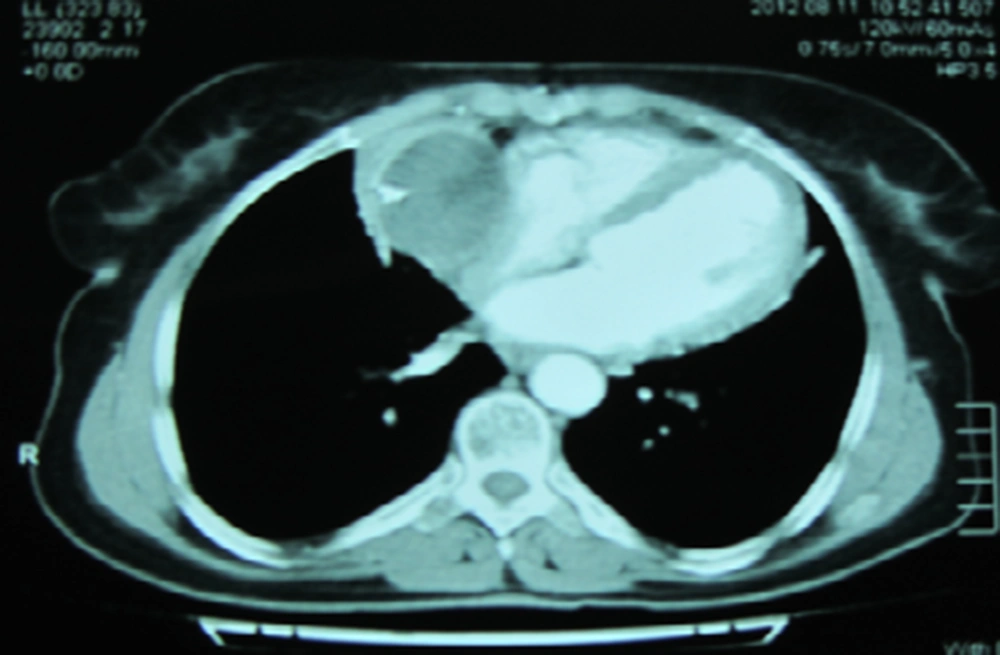 Shows Intra Pericardial Cyst Attached to Right Atrium Shows Intra Pericardial Cyst Attached to Right Atrium