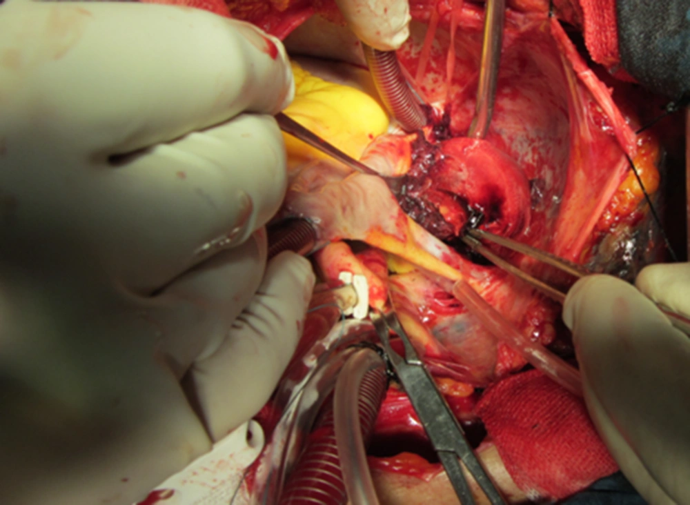 Shows Intra Operative View of Pericardial Cyst Shows Intra Operative View of Pericardial Cyst