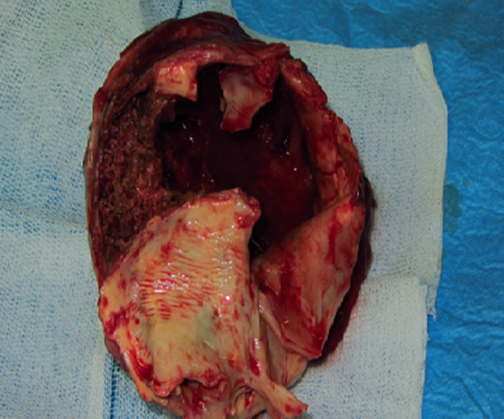 Shows Resected Cyst with Thick and Inflamed Wall Shows Resected Cyst with Thick and Inflamed Wall