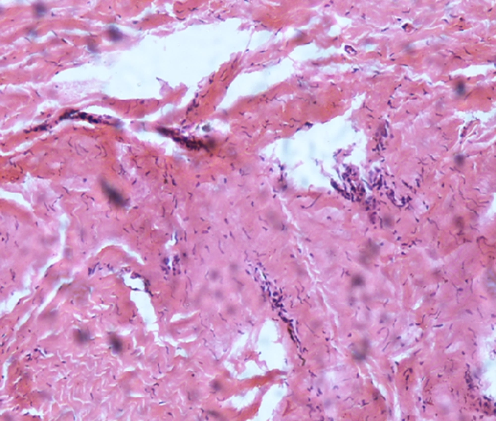 Shows Pericardial Histology with Some Inflammatory Cell (H, E 100) Shows Pericardial Histology with Some Inflammatory Cell (H, E 100)