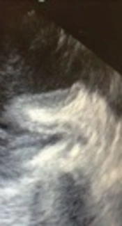 A Case Report of Left Atrial Appendage Invagination in Post Operation Setting