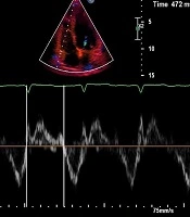 Right Ventricular Function in Heart Failure Patients with Normal Left Ventricular Size: Analysis by Conventional Echocardiographic Parameters and Magnetic Resonance Imaging