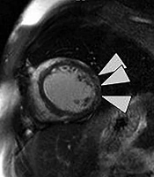 Post-Partum Cardiomyopathy in a Duchenne Carrier: A Case Report