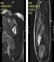 Left Ventricular Thrombus as a Cause of Recurrent Episodes of Transient Ischemic Attack While on Rivaroxaban in a Patient with Hyperhomocysteinemia