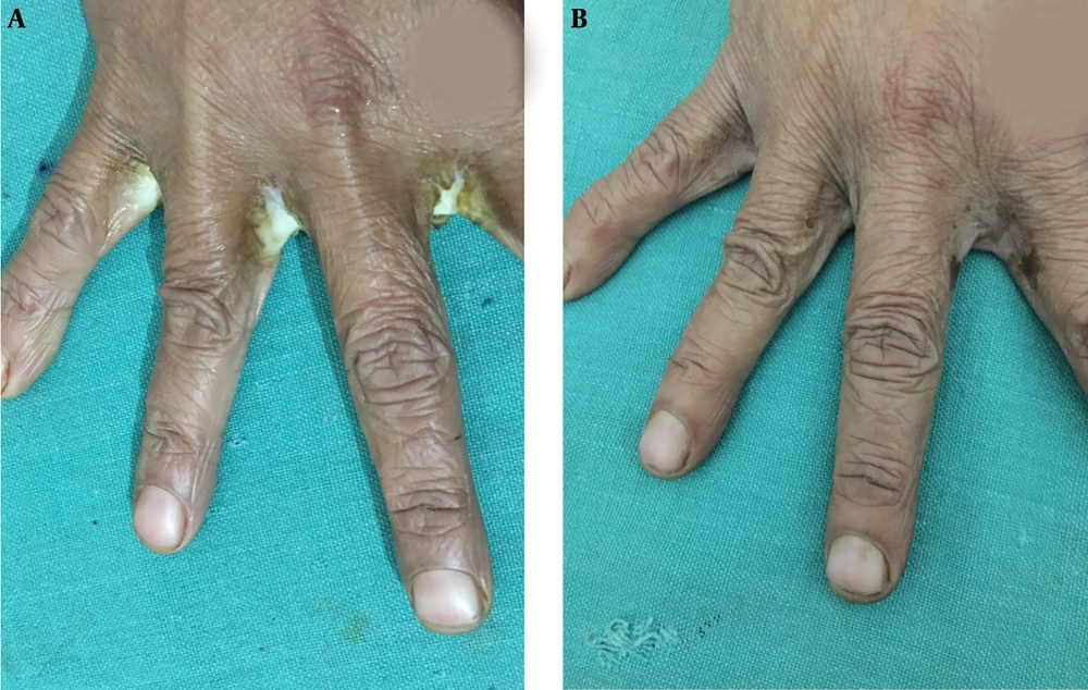 A, The clinically diagnosed candidal finger web intertrigo treated with sodium hypochlorite. B, The intertrigo resolved after 2 weeks. A, The clinically diagnosed candidal finger web intertrigo treated with sodium hypochlorite. B, The intertrigo resolved after 2 weeks.