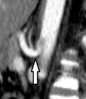 Median Arcuate Ligament Syndrome with Common Hepatic and Splenic Arteries Directly Originating from the Abdominal Aorta: A Case Report