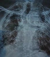 A Case Report of Co-existence of Chronic Silicosis and Pulmonary Tuberculosis in an Active Smoker