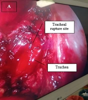 A Case of Bronchogenic Cyst with Tracheal Complication: Surgical Resection and Repair via Uniportal VATS