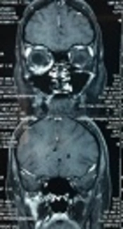 A Female Patient with Intraorbital Varix: A Case Report