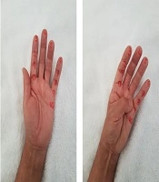 Effectiveness of Physical Therapy Plus TIOBEC® (α-Lipoic Acid + Vitamin B, C, and E) on Complex Regional Pain Syndrome (CRPS): A Small Case Series/Pilot Study