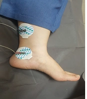 Cover image of the article: The Effect of Transcutaneous Posterior Tibial Nerve Stimulation on the Overactive Bladder in a Child: A Case Study