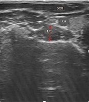 Correlation Between Craniovertebral Angle and Thickness of Longus Colli in Women with and Without Forward Head Posture