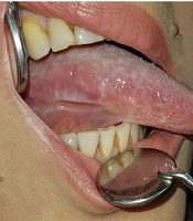 Management of Lichen Planus in a Post Liver Transplant Patient with Lupus Erythematosus, and Ulcerative Colitis; A Case Report