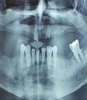 Incidence of Carotid Atheroma in Patients Received Radiotherapy in Neck Field-A Case Series Study