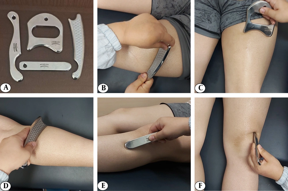 A, Instrument-assisted soft tissue mobilization (IASTM) tools and techniques; B, fanning; C and D, sweeping; E, brushing; and F, framing. A, Instrument-assisted soft tissue mobilization (IASTM) tools and techniques; B, fanning; C and D, sweeping; E, brushing; and F, framing.