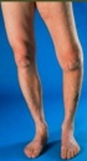 Ozone Decreases Biomarkers of Inflamation (C-Reactive Protein and Erytrocyte Sedimentation Rate) and Improves Pain, Function and Quality of Life in Knee Osteoarthrtitis Patients: A Before-and-After Study and Review of the Literature