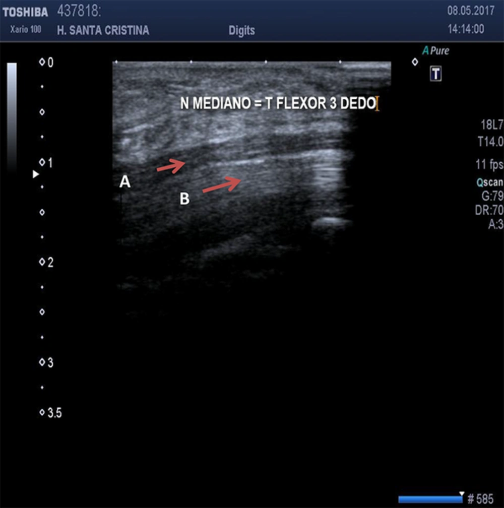 At the Wrist, the Fascicular Pattern of the Median Nerve (A and Arrow) is Quite different If Compared to the Fibrilar Pattern of the Flexor Tendons (B and arrow) Because of anechoic lines Observed Due to the Connective Tissue That Encircles Such Structures. At the Wrist, the Fascicular Pattern of the Median Nerve (A and Arrow) is Quite different If Compared to the Fibrilar Pattern of the Flexor Tendons (B and arrow) Because of anechoic lines Observed Due to the Connective Tissue That Encircles Such Structures.