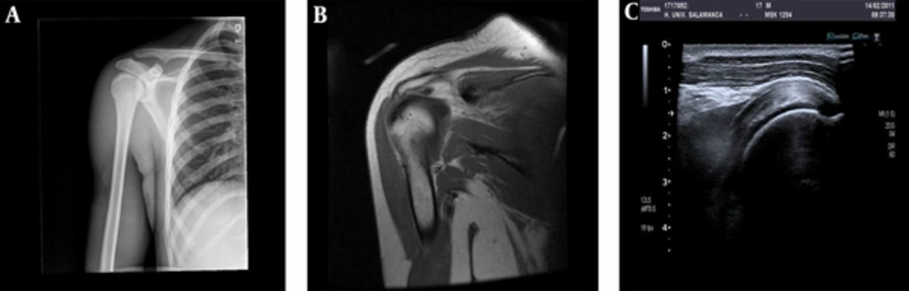 Shoulder evaluation: Radiography (A) and MRI (B) images have an anatomic representation, however, on an US (C), images are harder to understand. Shoulder evaluation: Radiography (A) and MRI (B) images have an anatomic representation, however, on an US (C), images are harder to understand.