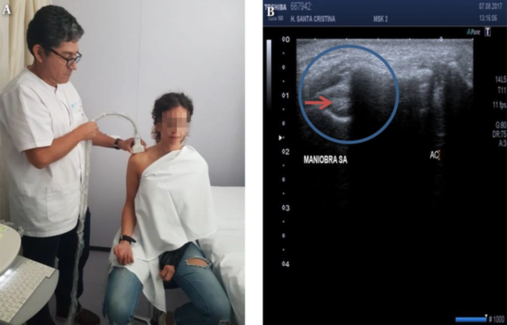 Evaluation of subacromial impingement by US evaluation A, Position of the linear probe over acromiun process is observed; B, Supraspinatus tendon (red arrow) is observed to get into the subacromiun space (encircled space). If space is shorter than 9 mm, this denotes subacromial impingement.