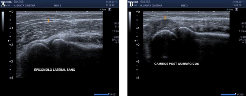 Imagen of a Healthy Tendon (A) Compared to a Post-Surgical Tendon at the Elbow (B) The tendon of extensors of the wrist shows a not well defined pattern (Arrow in B) If compared to the contralateral side (arrow in A). This denotes epicondylitis.