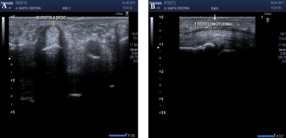 Imagen Shows Liquid Around the Flexor Tendon of the 3rd Finger in Its Short Axis (Arrow in A) and on Its Log Axis (Arrow in B) This denotes tenosynovitis.