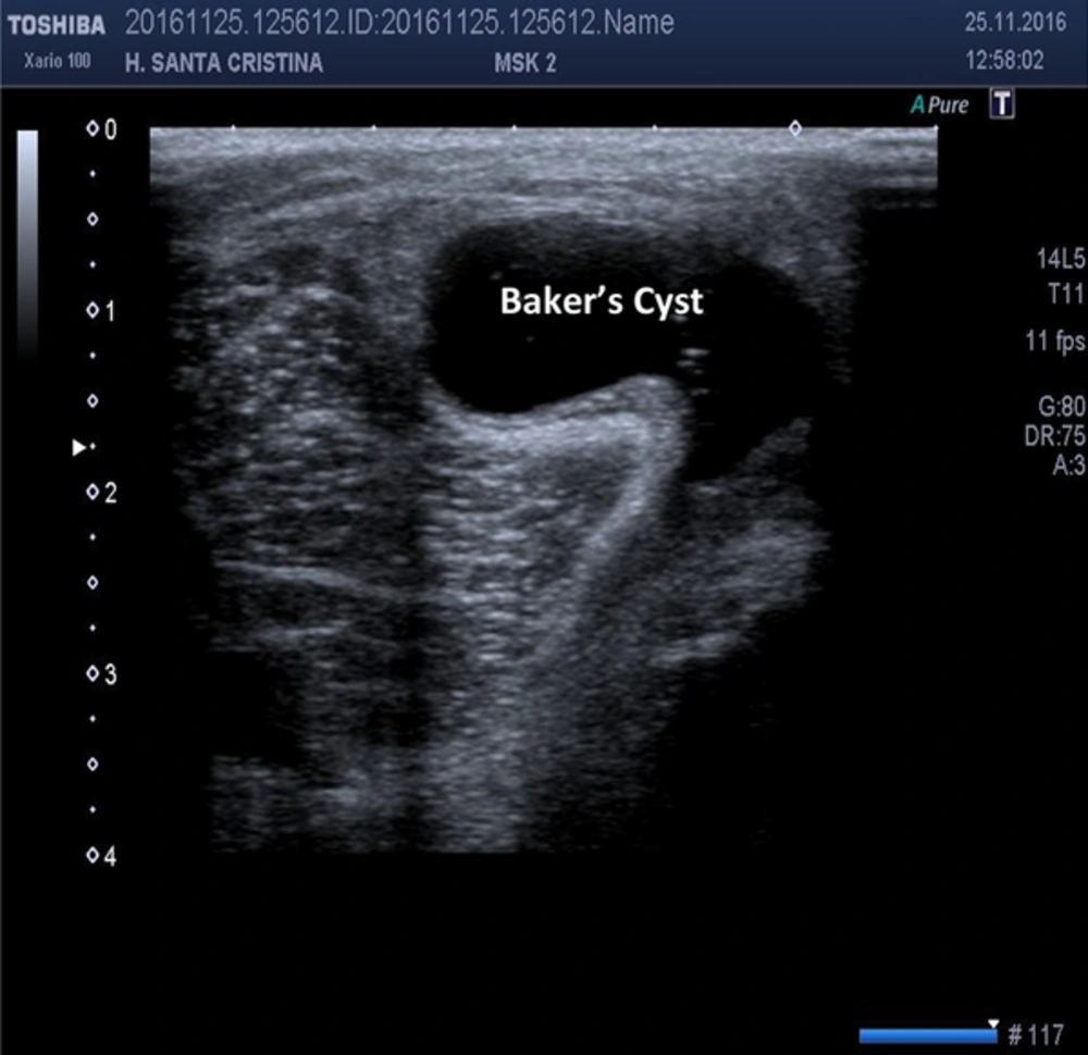 In the 1970s, Baker’s Cyst Was the First Indication for Evaluation of Ultrasound on Musculoskeletal Pathology. In the 1970s, Baker’s Cyst Was the First Indication for Evaluation of Ultrasound on Musculoskeletal Pathology.